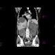 Polycystosis of liver and kidney: CT - Computed tomography